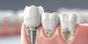 Ursachen und Konsequenzen bei Implantatverlust