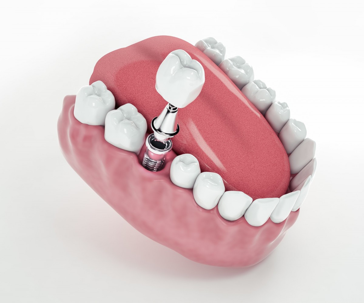 Implantate – Ihr langlebiger Zahnersatz Implantate – Ihr langlebiger Zahnersatz